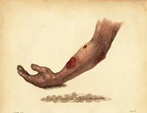 Sore: Abscess from a gunshot wound in the forearm, 1815