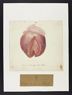 Pitie: Abscess (Heart)