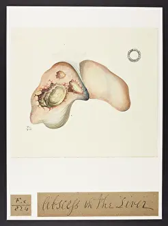 Liver: Abscess in the Liver