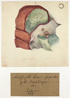 Liver: Abscess in the Liver. Perforation of the Diaphragm