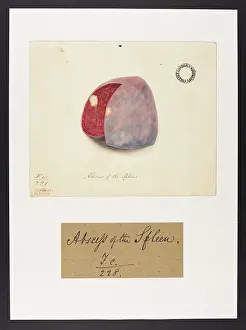 Hopital: Abscess of the Spleen