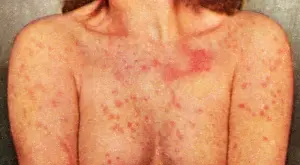 Acute: Acute Psoriasis