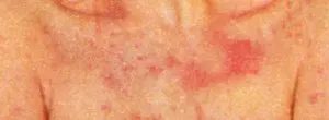 Acute: Acute Psoriasis
