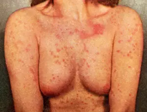 Acute: Acute Psoriasis
