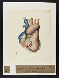Dilatation: Adhesion of the Pericardium, Dilatation of Arch of Aorta