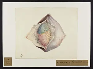 Unsigned: Adhesions of Pericardium