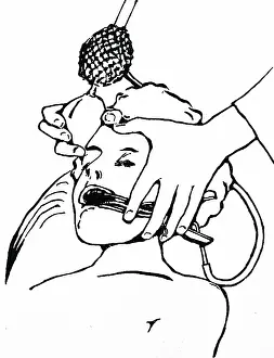 Removal: Administering chloroform using a Junker's inhaler:
