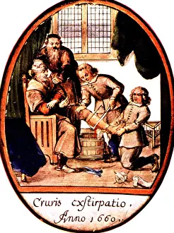 Sawing: Amputation, 1660
