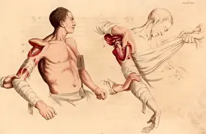 1821: Amputation of the arm at the shoulder. On the