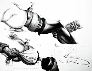 1821: Amputation of the leg at the thigh. From Charles