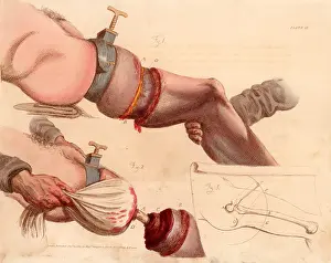 1821: Amputation of the leg at the thigh. The tourniquet