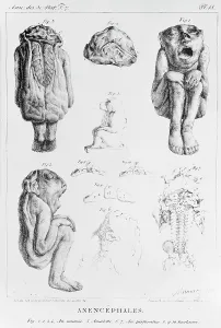Deformed: Anencephales, deformed foetus