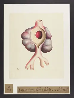 Faint: Aneurysm of the Abdominal Aorta