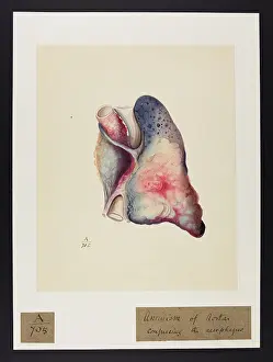 Verso: Aneurysm of Aorta Compressing the Oesophagus