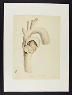 Aorta: Aneurysm of Arch of Aorta