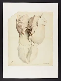 Blank: Aneurysm of Arch of Aorta