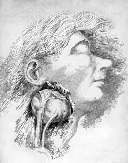 Brains: Aneurysm of the Carotid Artery