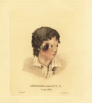 Ulcers: Aneurysmal tumor on the face of a young boy N, 1815
