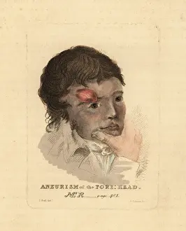 Ulcers: Aneurysmal tumor on the forehead of a young man, 1815