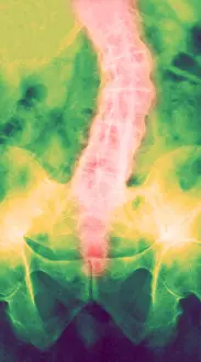 Impaired: Ankylosing Spondylitis, X-Ray
