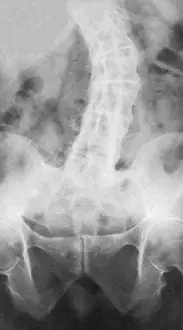 Impaired: Ankylosing Spondylitis, X-Ray