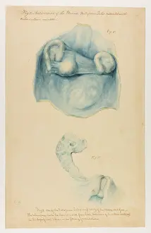 Tubes: Antiversion of Uterus: Fallopian Tubes Distended