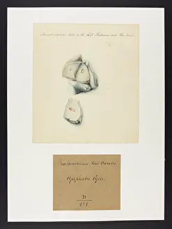 Pons: Apoplectic Cysts