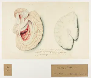 Brain: Apoplexy of Brain and Serous Cysts