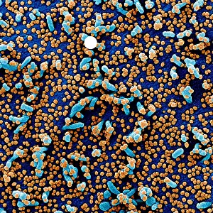 Sars: Apoptotic cell (blue) infected with SARS-COV-2