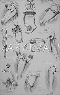 Forceps: ARRESTING BLEEDING/C1850