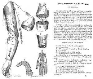 Surgery: Artificial arm by Bechard
