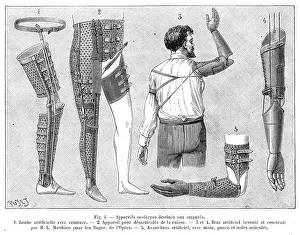 Surgery: Artificial leg and arm