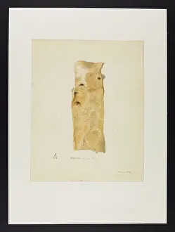 Blank: Atheroma of the Aorta