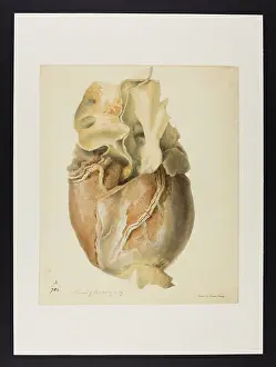 Blank: Atheroma of the Coronary Artery