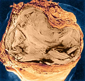Blockage: Atherosclerosis SEM, full blockage