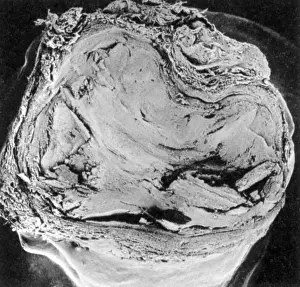 Blockage: Atherosclerosis SEM, full blockage