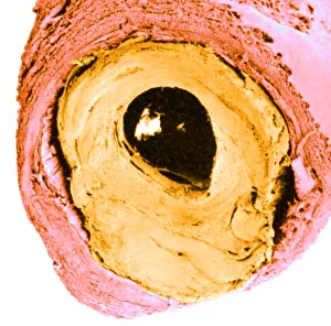 Blockage: Atherosclerosis SEM, partial blockage