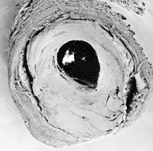 Blockage: Atherosclerosis SEM, partial blockage