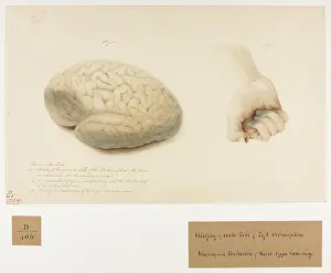 Femmes: Atrophy of Anterior Lobe of Left Hemisphere