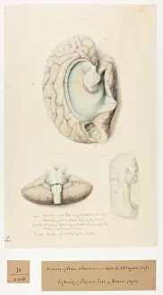 Brain: Atrophy of corpus striatum and medulla oblongata
