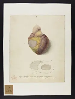 Hopital: Atrophy of Heart & Hypertrophy of Left Ventricle