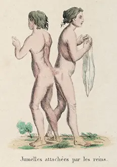 Deformities: ATTACHED TWINS