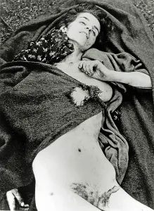 Dysentery: Bergen-Belsen Concentration Camp - Corpse of a woman