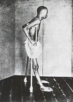 Casimir: Beriberi Patient, 1914