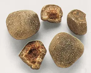 Gastrointestinal: Bezoar Stones