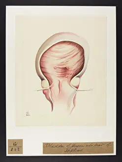 Typhus: Bladder: Typhus