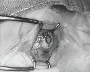 Eyelid: Blind boy's sight restored by surgery