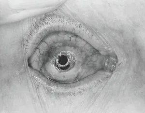 Eyelid: Blind boy's sight restored by surgery