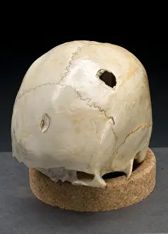Crush: Blunt Force Hammer Trauma to Skull, 1950's