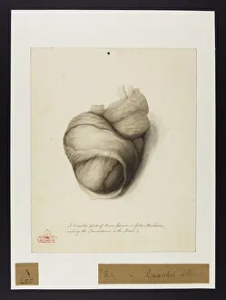 Hopital: Bone in Pericardial Adhesions
